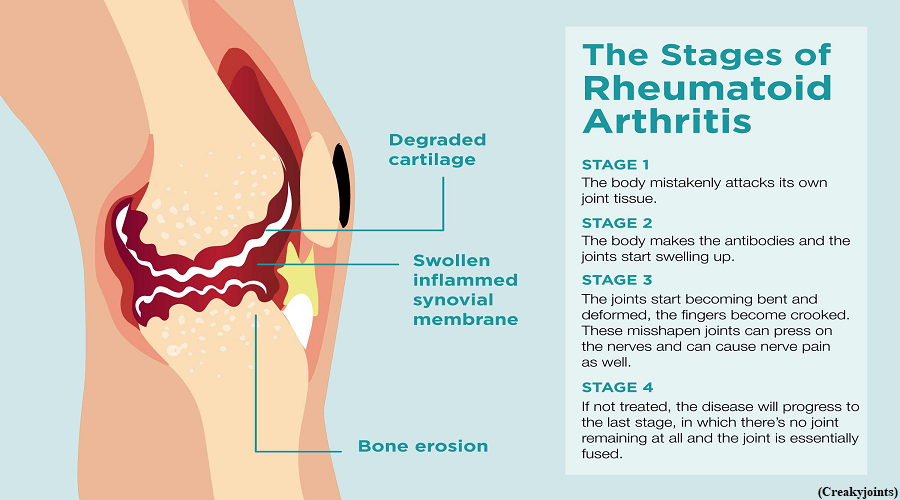 Can rheumatoid arthritis be prevented? (GS Paper 2, Health)